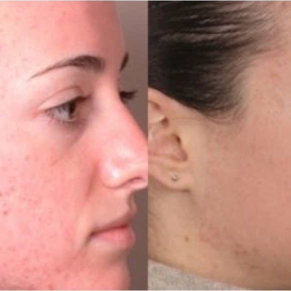 Shani Darden by Déesse PRO LED Light Mask FDA approved 
LED Light Therapy mask - Picture 11 of 12